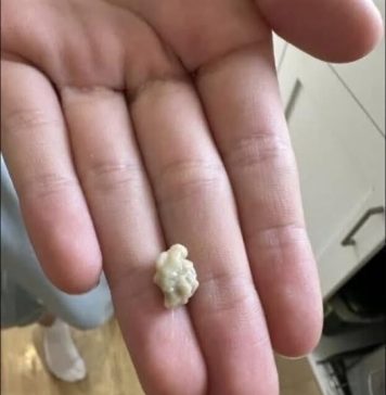 “Neočekivano i šokantno iskustvo: Ono što je izašlo iz mog grla će vas ostaviti bez riječi 😳” “Neočekivano i šokantno iskustvo: Ono što je izašlo iz mog grla će vas ostaviti bez riječi 😳” - featured image